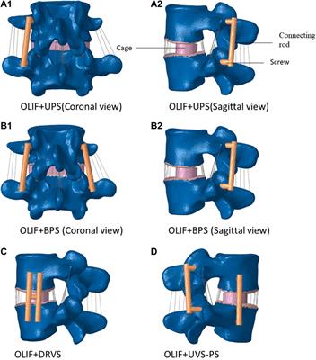Biomechanical stability of oblique lateral interbody fusion combined with four types of internal fixations: finite element analysis
